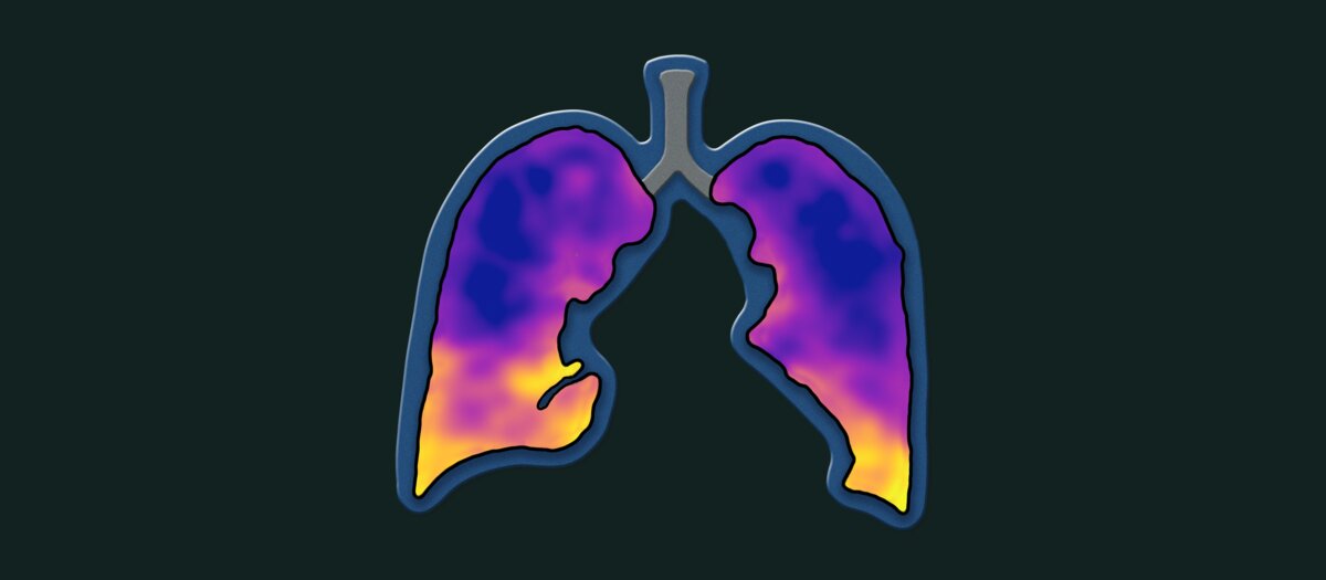 CT:VQ colour map of both lungs, where colour reflects regional lung function