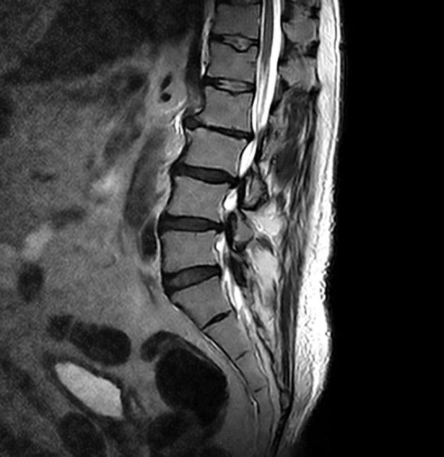 Sagittal MRI of the spine