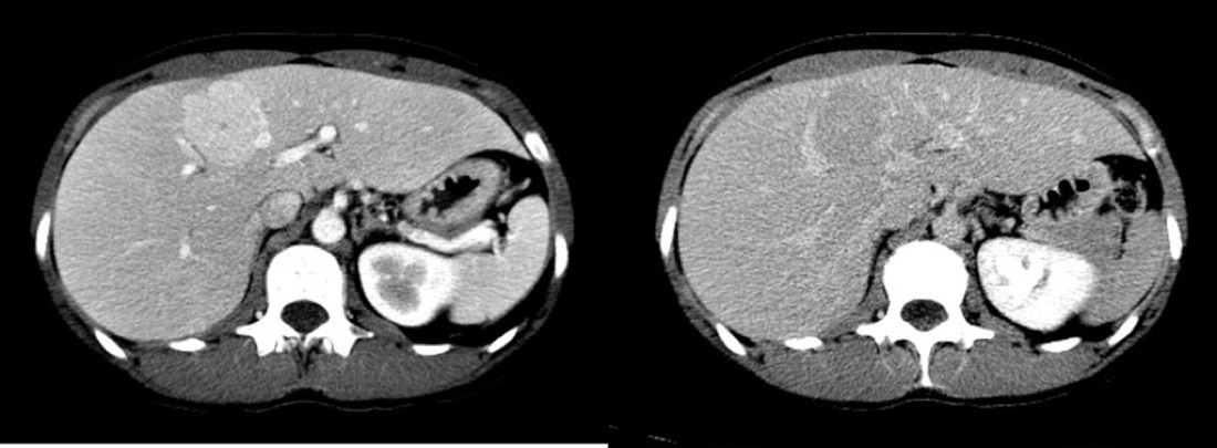 Contrast-enhanced CT of the abdomen