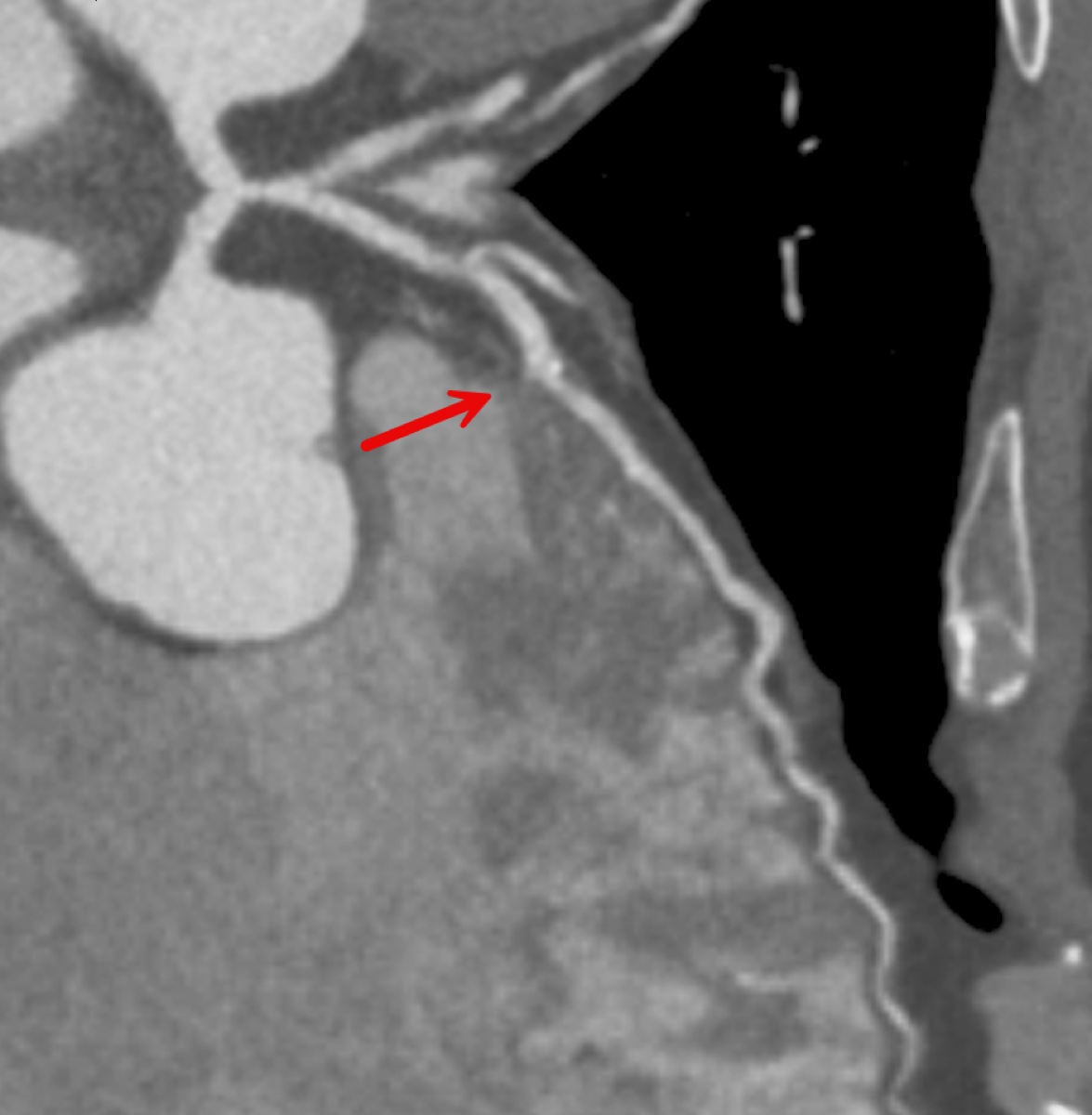 CTCA curved reconstruction showing mixed plaque in the left anterior descending coronary artery, marked with an arrow