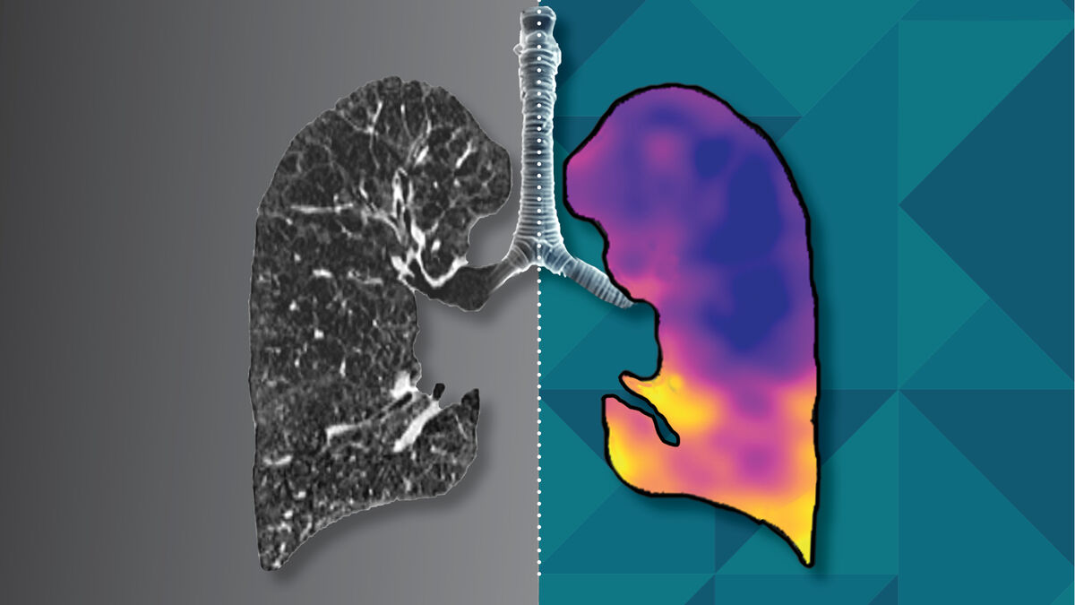 Side by side: a conventional greyscale CT image of one lung next to a CT:VQ colour map of the other lung, joined at the trachea