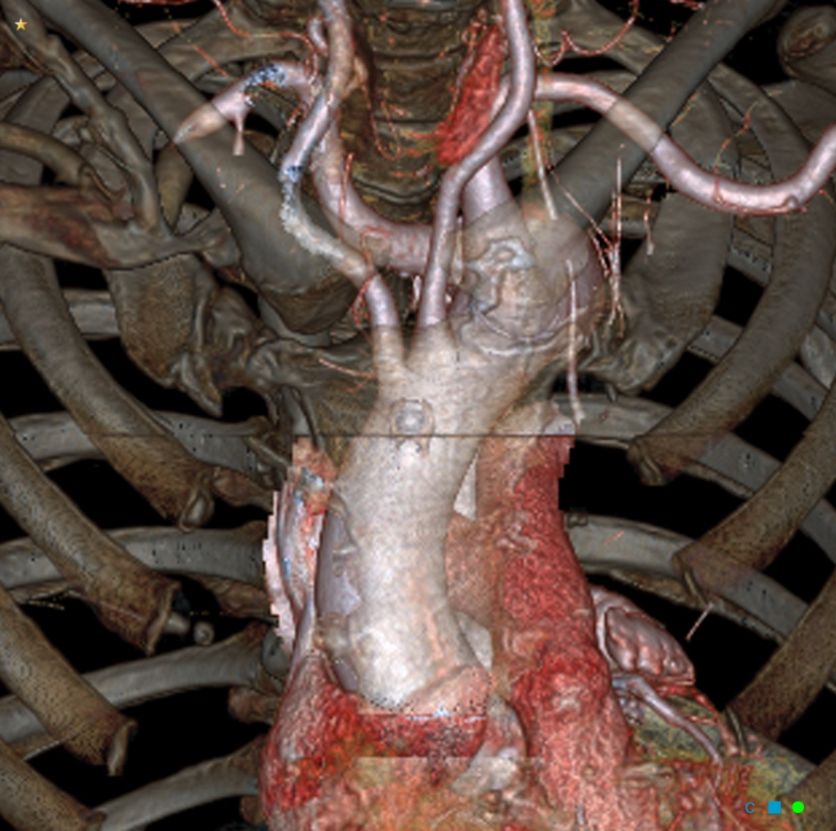 3D reconstruction from a TAVI workup CT angiogram showing the aortic arch with an aberrant right subclavian artery