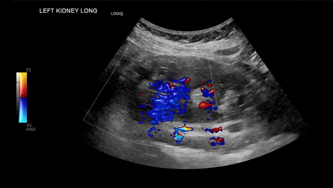 Doppler ultrasound imaging